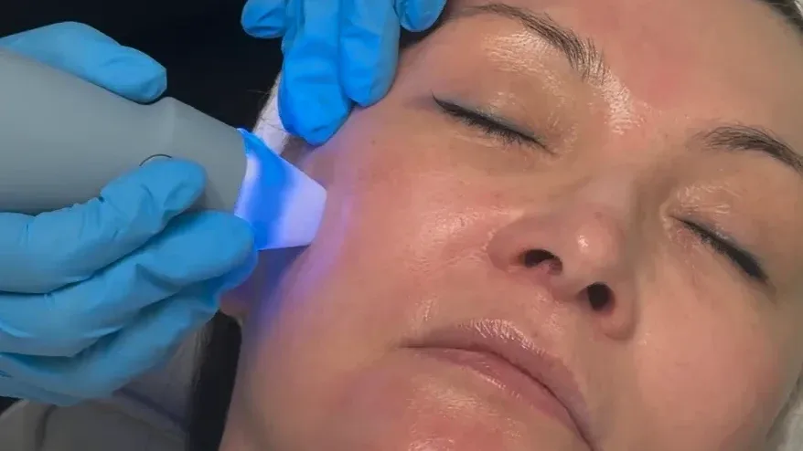 What to Expect from RF Microneedling: A Week-by-Week Timeline