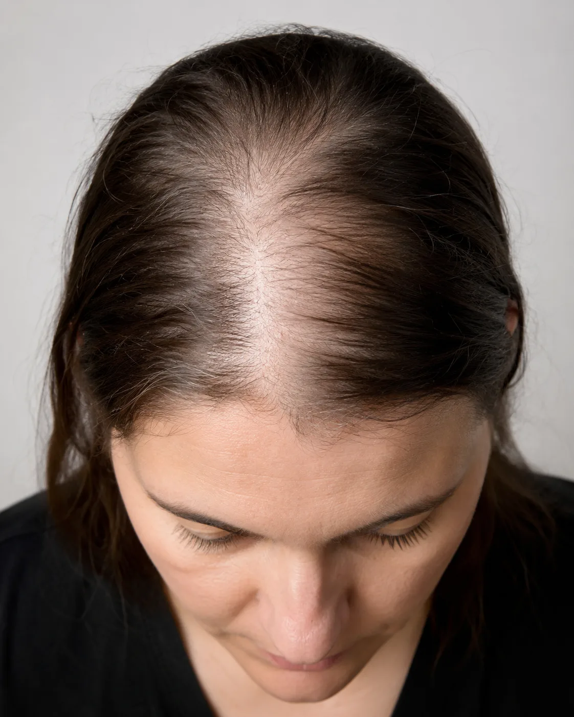 Reduced hair density