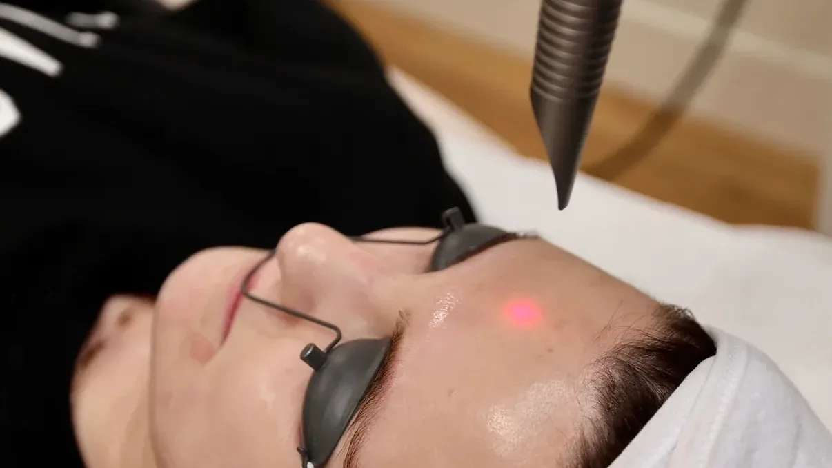 Laser — in clinic