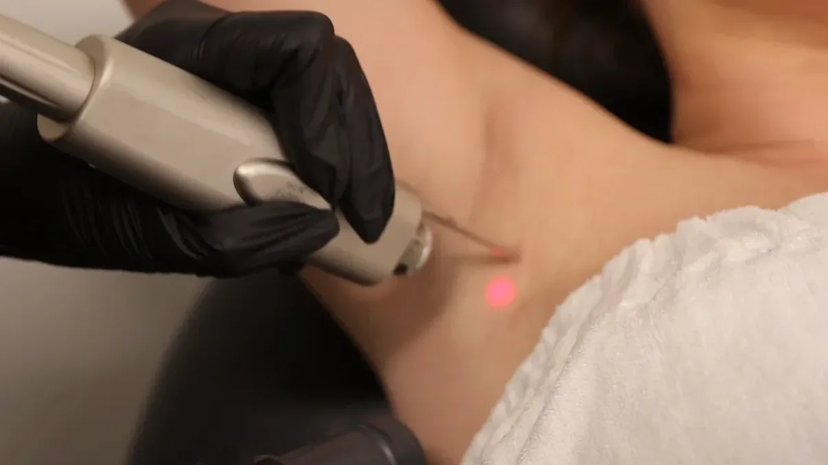 Laser Hair Removal in Vancouver: Everything You Need to Know