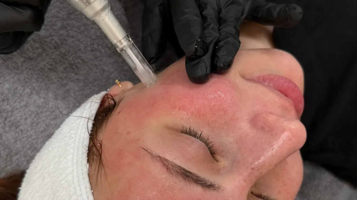 Microneedling — treatment