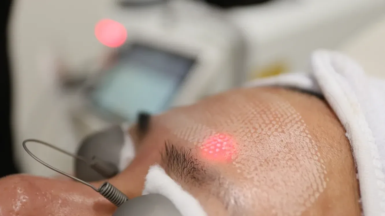 Laser — in clinic