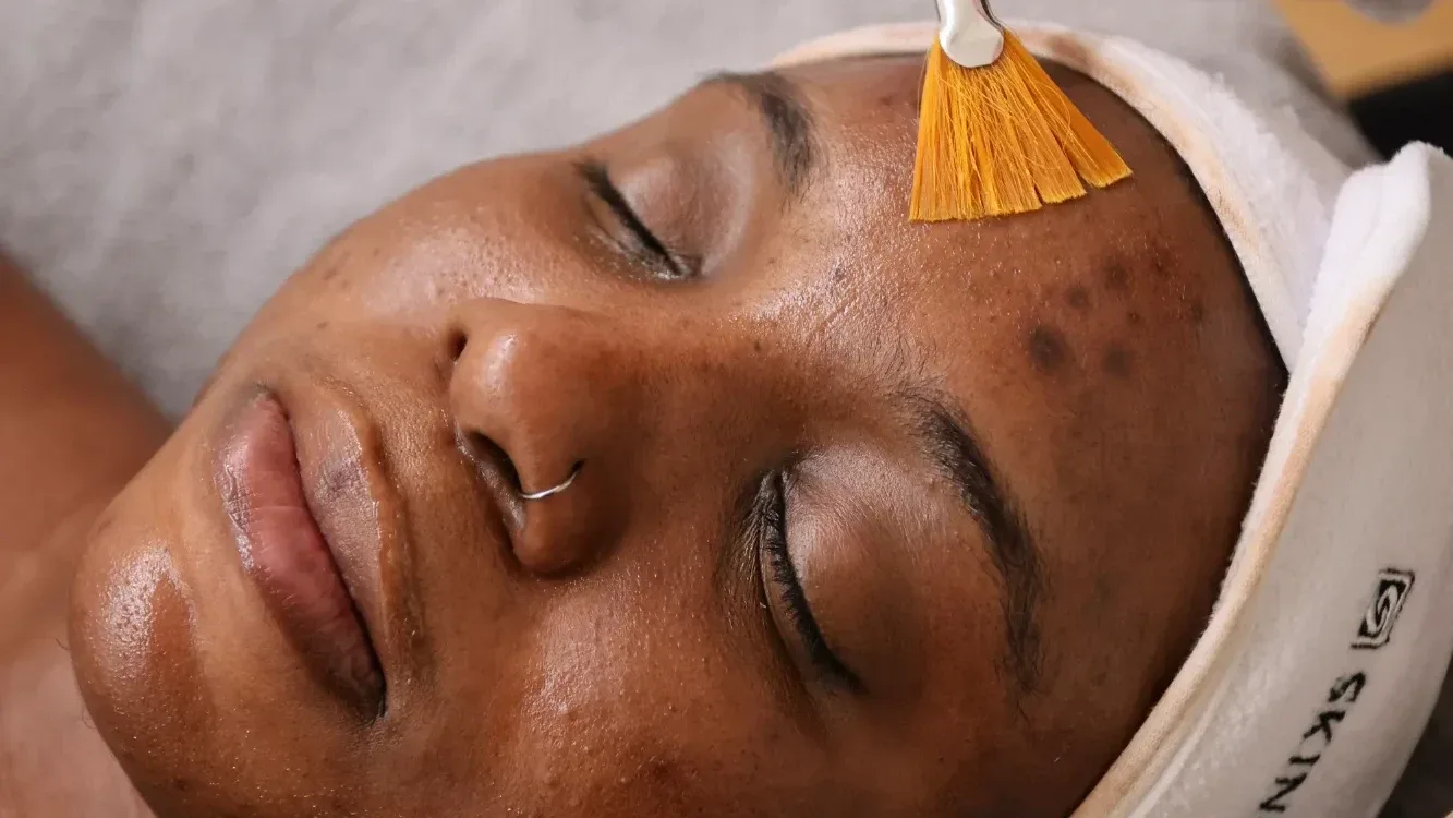 Chemical Peel Downtime: What Patients Need to Know